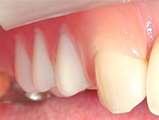 歯肉に近い素材のノンクラスプ義歯